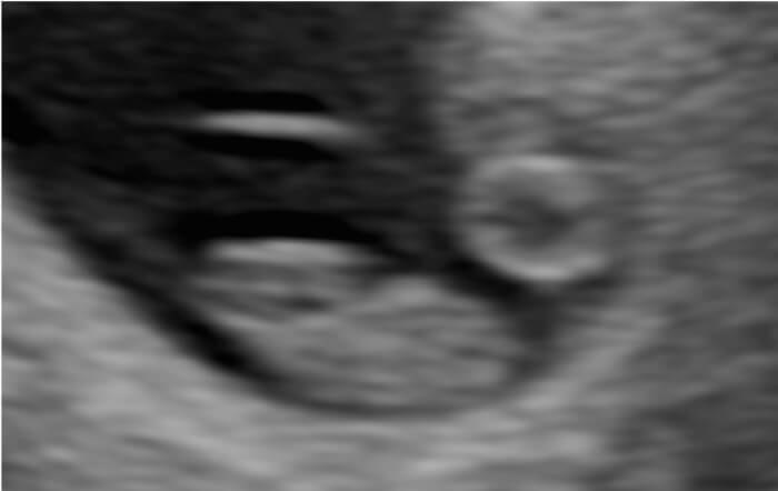 Ultrasound Early Reassurance 2D Scan