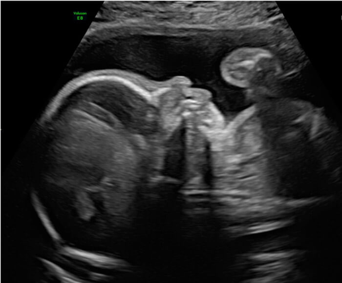 Gender reveal scan Ultrasound Baby